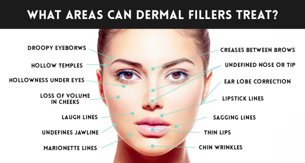 dermal-filler-info for wbsite