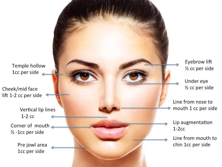 amount of fillers needed per treatment area