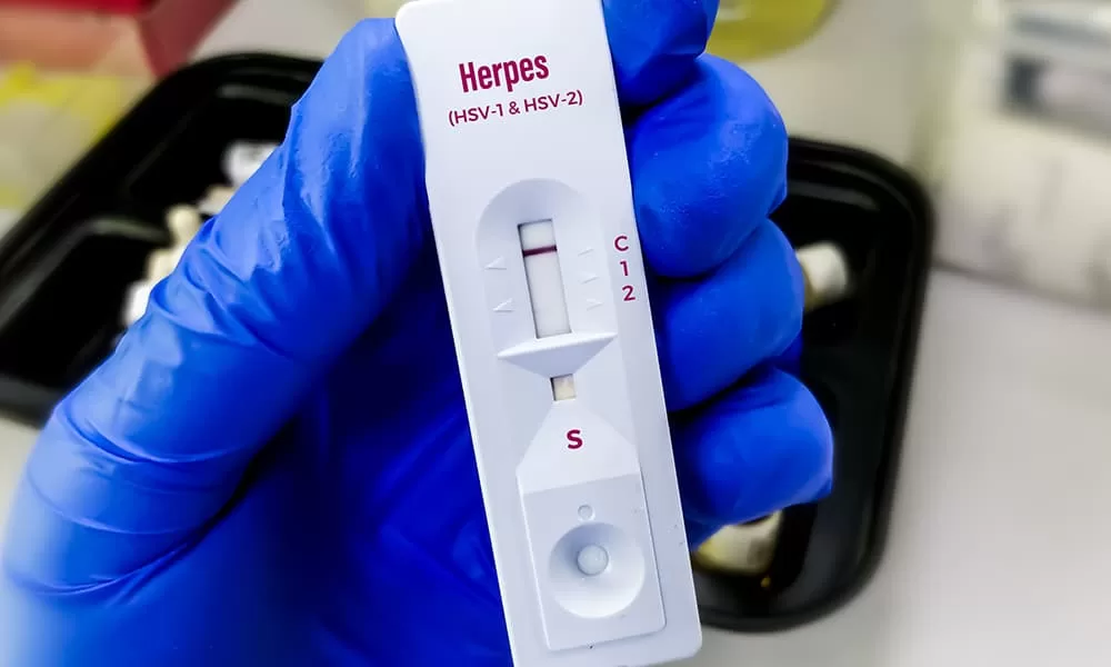 Herpes