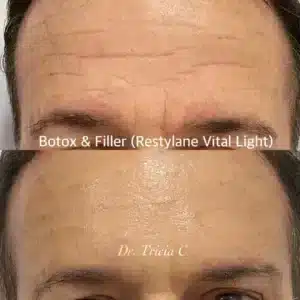 Botox & Filler