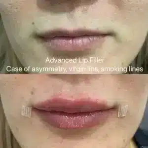Advanced Lip Filler