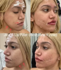 Jaw & Lip Filler
