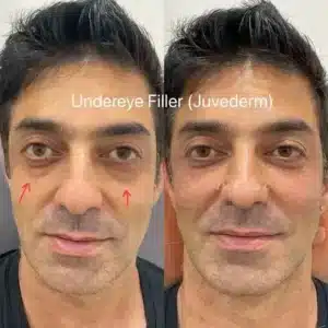 Undereye Filler