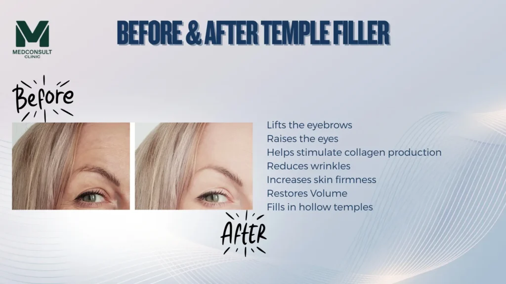 temple filler 4