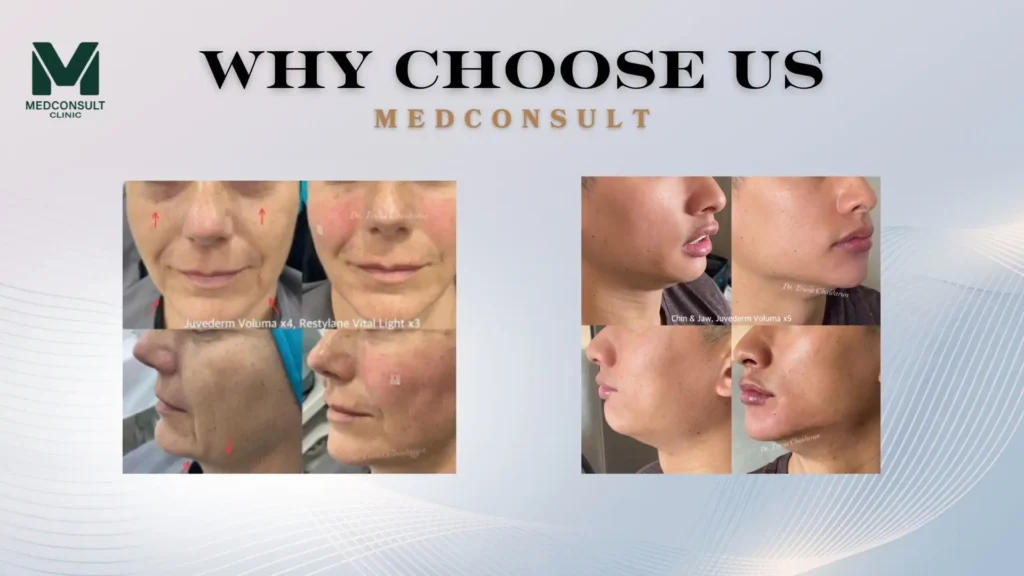 juvederm3