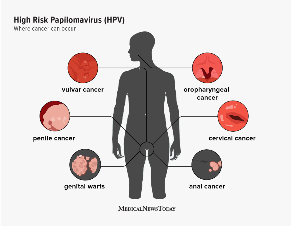 Unlocking the Power of HPV Vaccines: A Comprehensive Guide to Protection and Prevention 1 hpv symptoms 1296x1000 body 1024x793 1